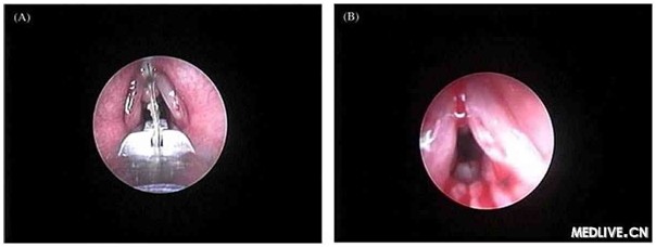    圖1. 采用鱷口鉗移除喉部異物(A)，緊接著的圖像顯示聲門前后的炎癥和肉芽組織(B)。